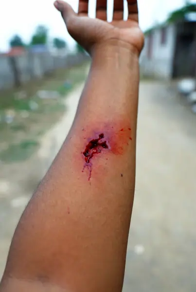 Dog bite wound — primary route of rabies transmission in India